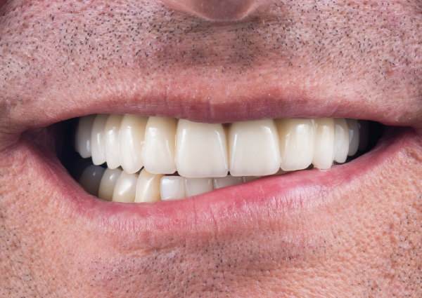 After-Male w/ Implant Posts