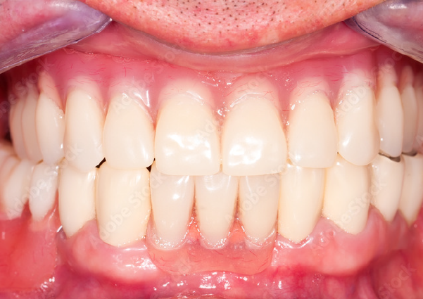 After-Major Tooth Loss and Restoration