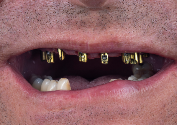 Before-Male w/ Implant Posts