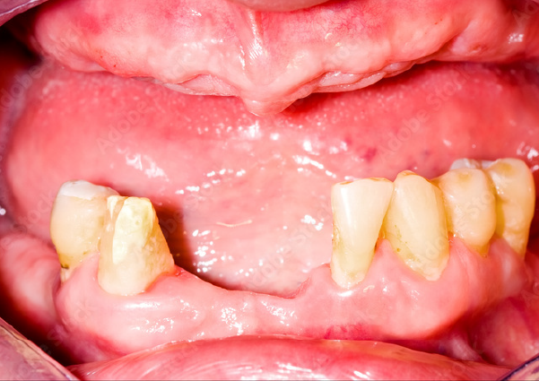 Before-Major Tooth Loss and Restoration